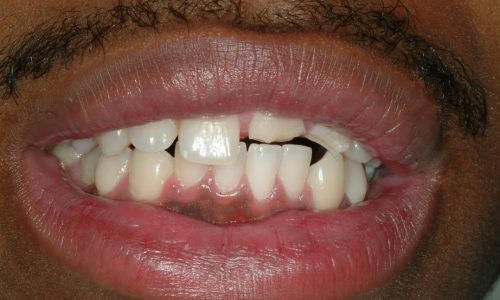 Before dental services at Annapolis Center For Dental Health & Wellness