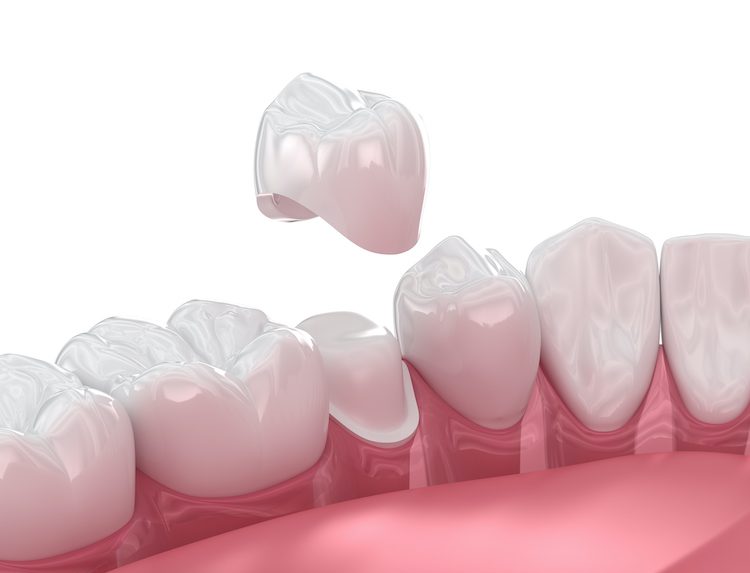 A lost dental crown does require prompt attention to protect your tooth and avoid further complications and sensitivity.