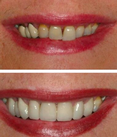 Before and After Cosmetic Dentistry in Annapolis MD