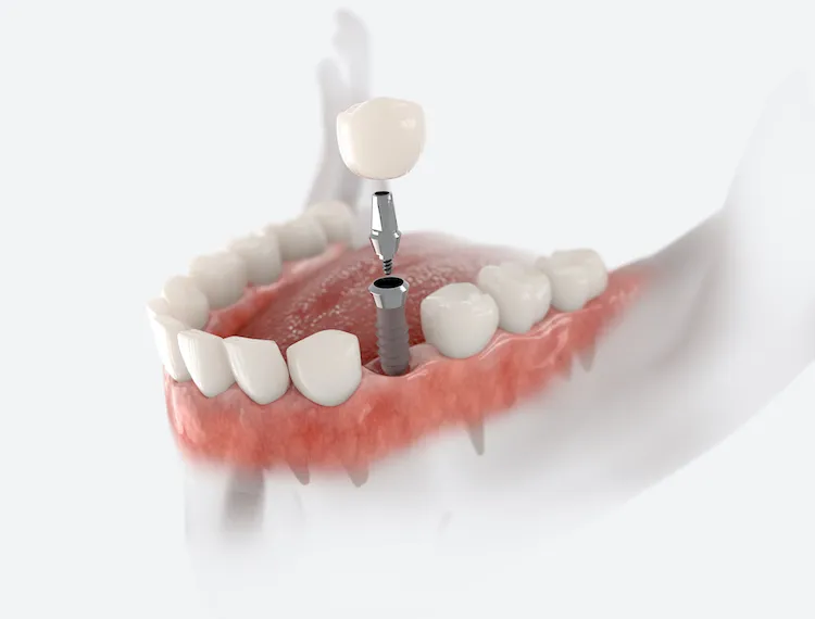 Dental Implants vs Bridges Annapolis MD