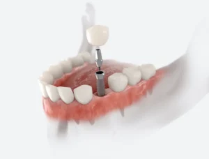 Dental Implants vs. Bridges: Which Is for You? in Annapolis, MD